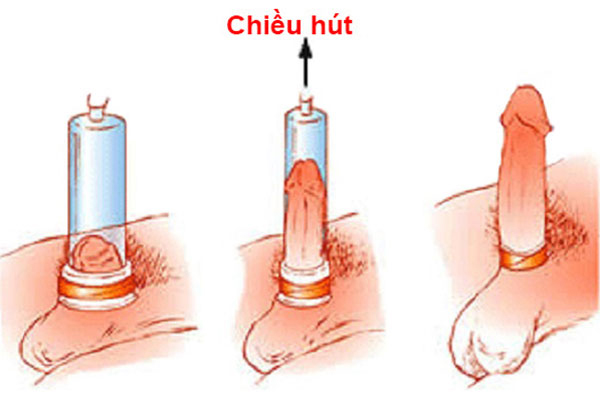 Áp dụng nguyên lý hút chân không để tăng kích thước cậu nhỏ Áp dụng nguyên lý hút chân không để tăng kích thước cậu nhỏ
